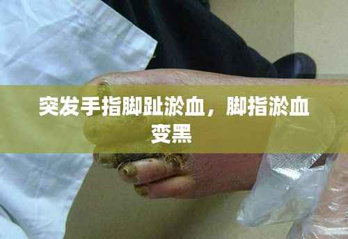 突发手指脚趾淤血,脚指淤血变黑